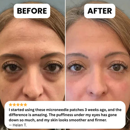 Urbanvelle Microneedle Under-Eye Patches