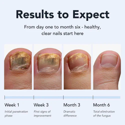 Kill Nail Fungus at the Root — Not Just the Surface