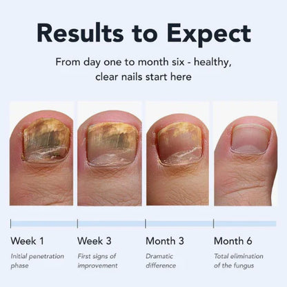 Kill Nail Fungus at the Root — Not Just the Surface