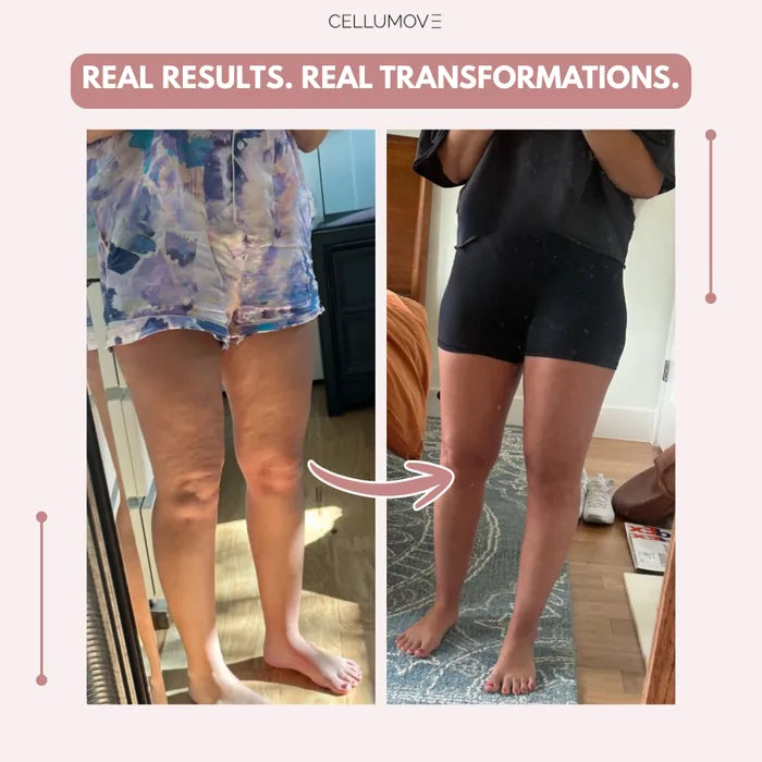 Urbanvelle 3D Legging – Say goodbye to lipoedema pain and swelling naturally