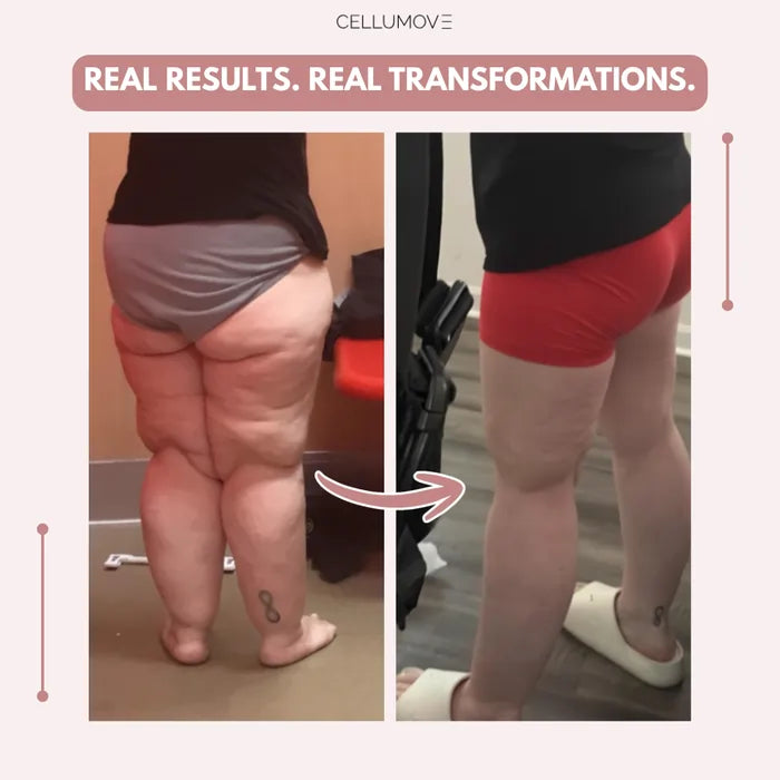 Urbanvelle 3D Legging – Say goodbye to lipoedema pain and swelling naturally