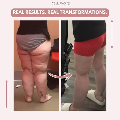 Urbanvelle 3D Legging – Say goodbye to lipoedema pain and swelling naturally