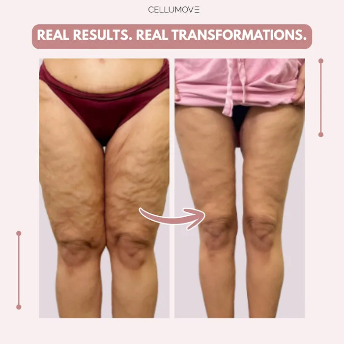 Urbanvelle 3D Legging – Say goodbye to lipoedema pain and swelling naturally