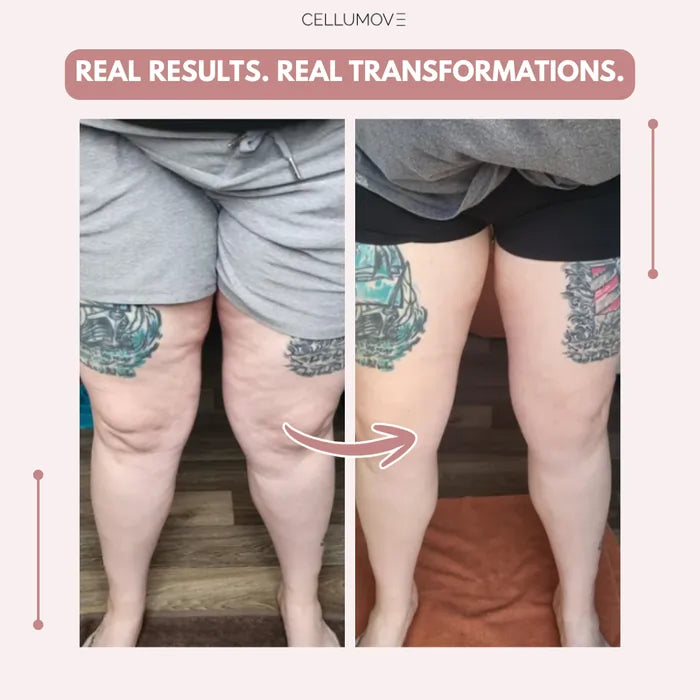 Urbanvelle 3D Legging – Say goodbye to lipoedema pain and swelling naturally