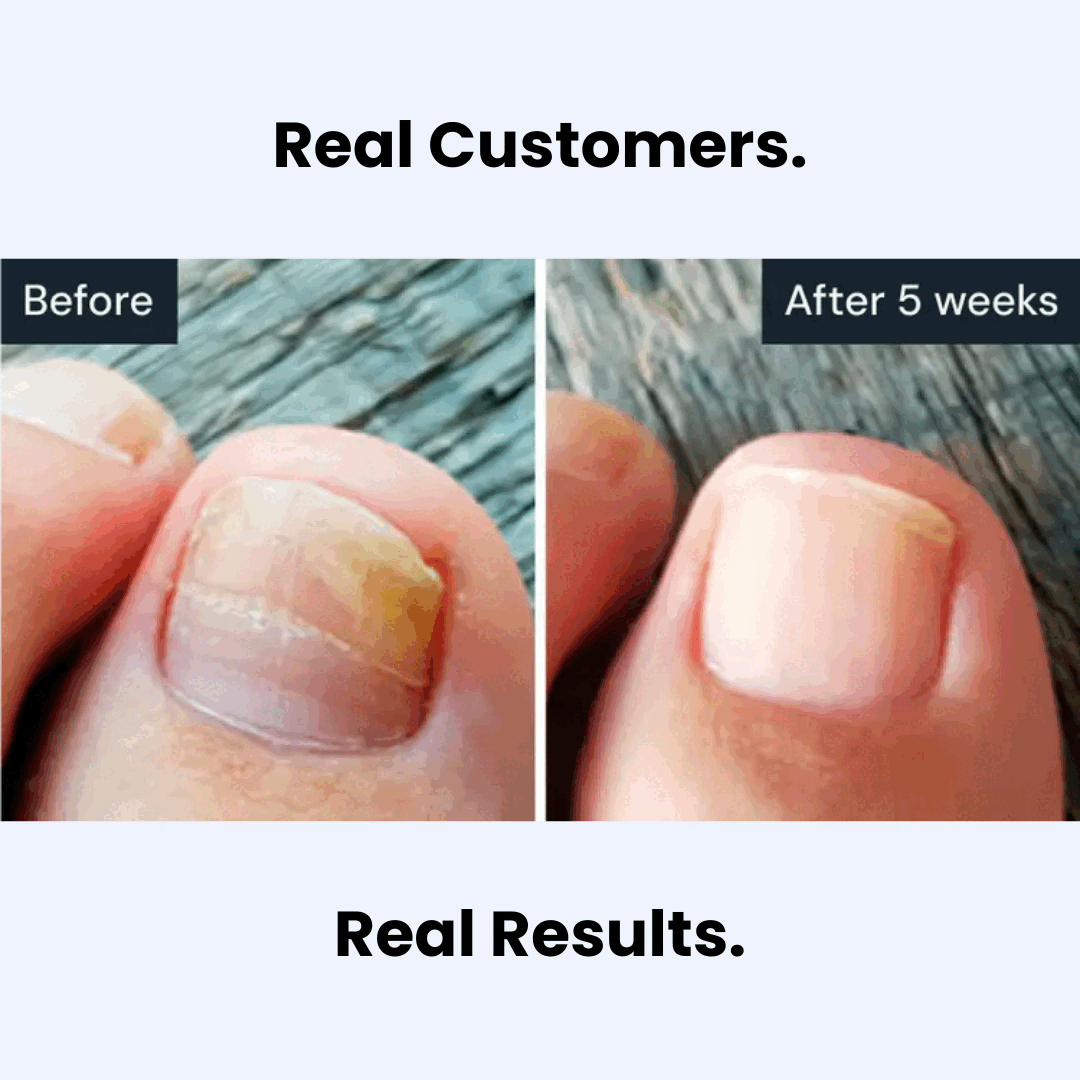 Kill Nail Fungus at the Root — Not Just the Surface