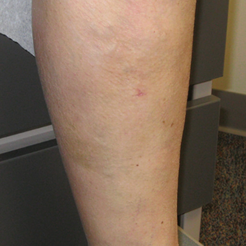 C-Varicose Vein Cream